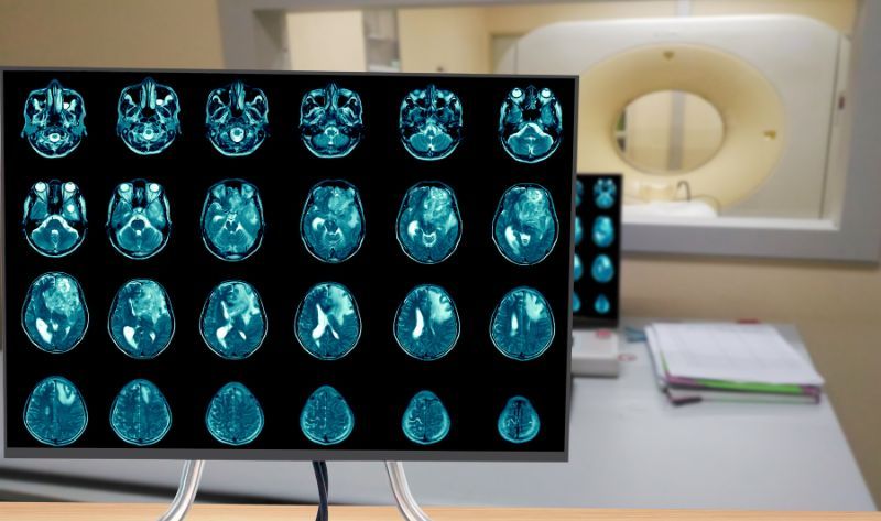 Šta je glioblastom?