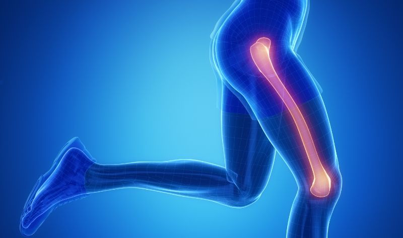 Prelom femura (Prelom butne kosti) 