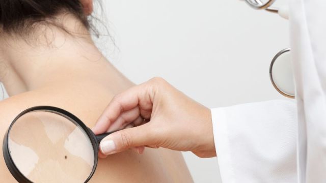 Tumori kože: simptomi, uzroci i prevencija Tumori kože: simptomi, uzroci i prevencija