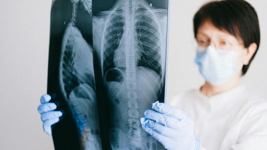 MSCT grudnog koša MSCT grudnog koša