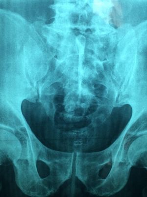 MSCT snimanje karlice