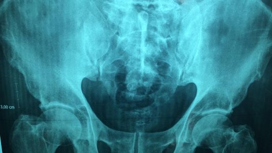 MSCT karlice MSCT karlice