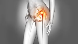 Razumevanje koksartroze: Šta je i kako utiče na zglobove kuka