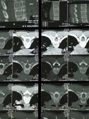 MSCT snimanje kičme