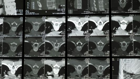 MSCT kičme MSCT kičme