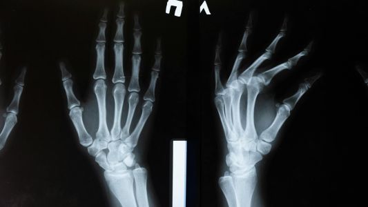 MSCT zglobova MSCT zglobova