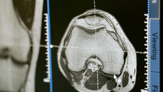 MR i procena raka prostate