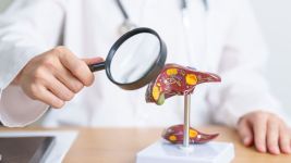 Šta je ascites i kako se dijagnostikuje?