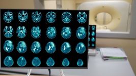 Glioblastom: Uzroci, simptomi i lečenje