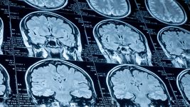 Ishemija mozga: vodič kroz prevenciju i tretman